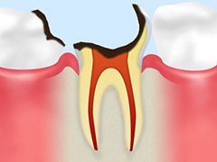C4：歯根にまで達した虫歯