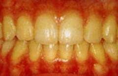 「歯周病」という病気のこと、ご存知ですか？～歯周病治療～