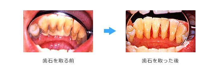 歯周病の治療は何をするの？